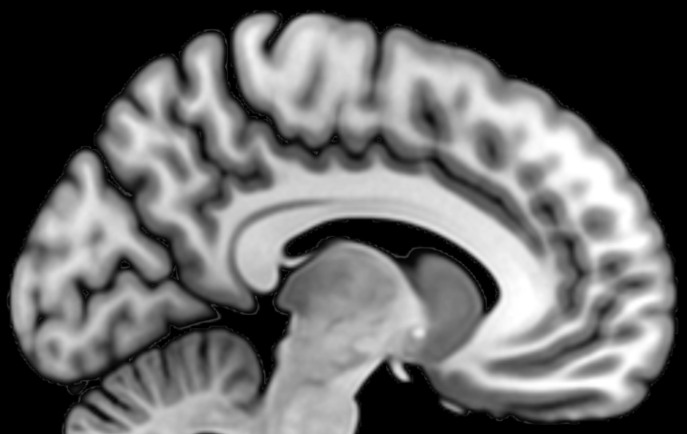 Magnetic Resonance Image of the Brain in blach and white.