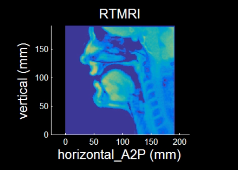 MRI-bild av talapparaten i genomskärning. Foto: Phil Hoole