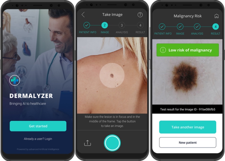 Dermalyzer, ett AI-stöd som hjälper läkare att diagnostisera hudcancer