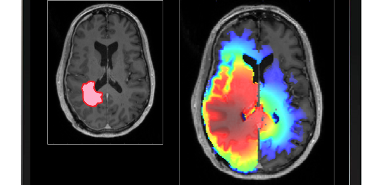 Personalised treatment planning for stereotactic radiotherapy of high-grade glioma