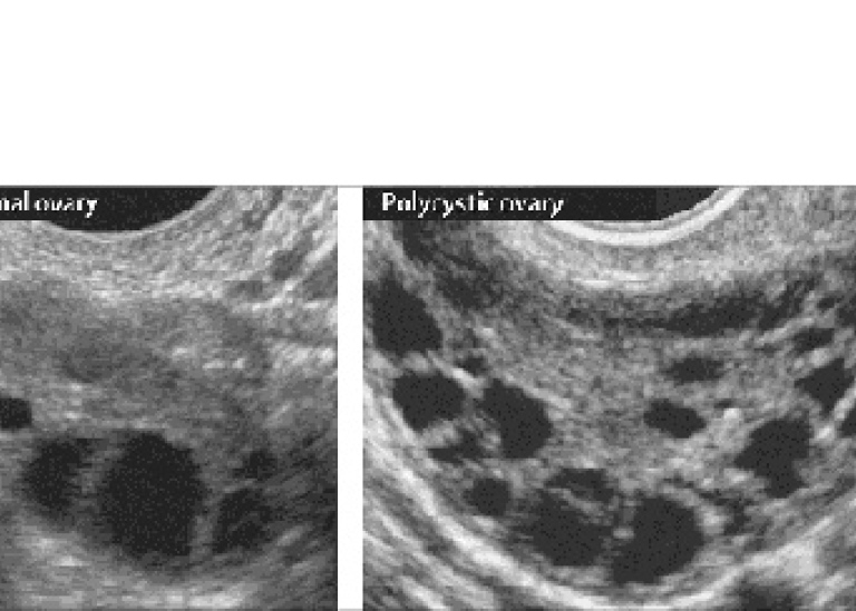 Ultraljudsbilder som visar en normal äggstock och en polycystisk äggstock.